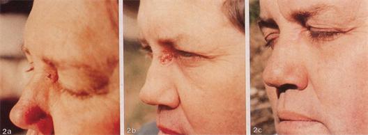 Why is Curaderm a better choice as a non-invasive medication for skin cancer?